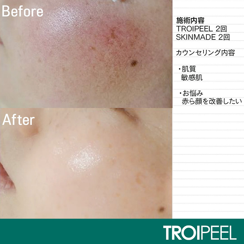 TROIPEEL効果 画像1