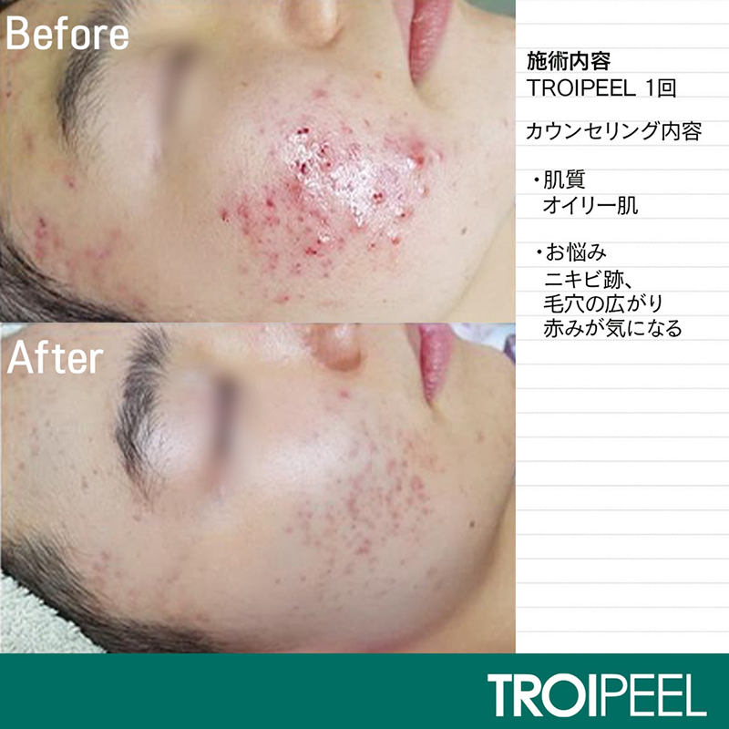TROIPEEL効果 画像2